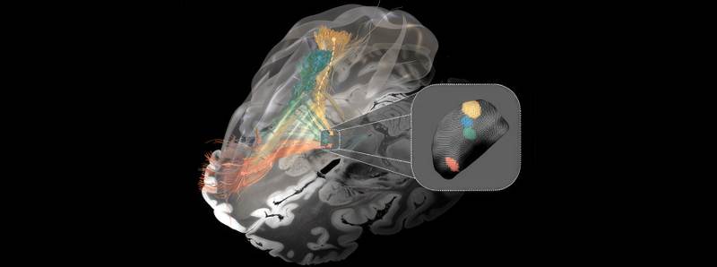 Mappa delle reti cerebrali interrotte